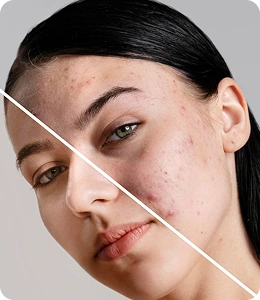 Before and after acne treatment showing clearer skin improvement